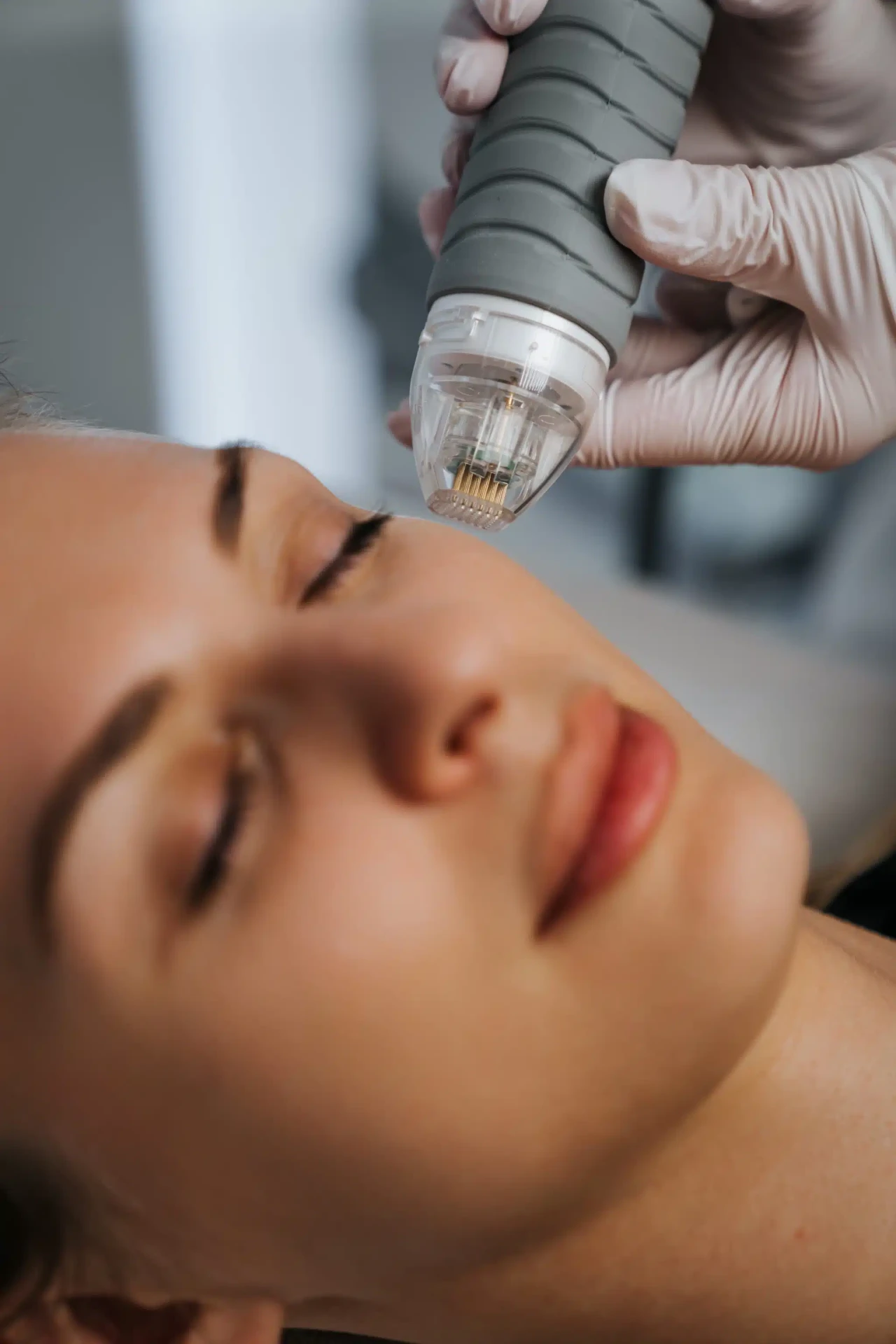 RF-Needling-Behandlung bei Glamour Cosmetics by Magdalena: Nahaufnahme einer liegenden Kundin, während das Handstück an der Wange geführt wird